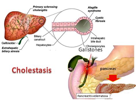 Cholestasis: Definition, Symptoms, Treatment, Causes